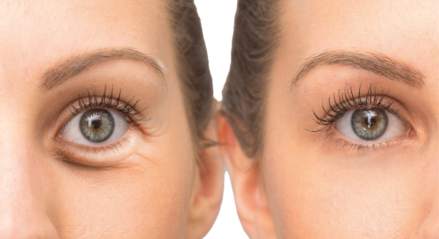 BLEPHAROPLASTY