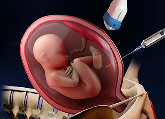 Chorionic Villus Sampling