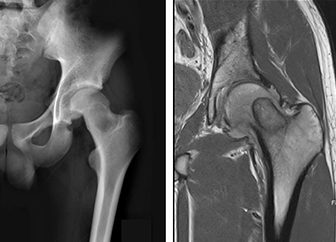 Comprehensive Pediatric Bone Tumor Management