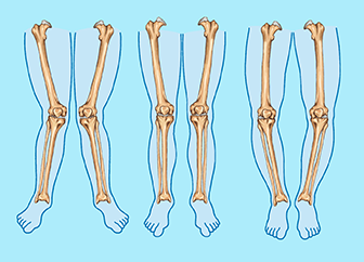 Early Detection and Management of Deformities Using Growth Modulation