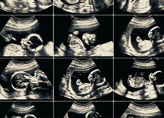 Foetal Diagnosis and Scans