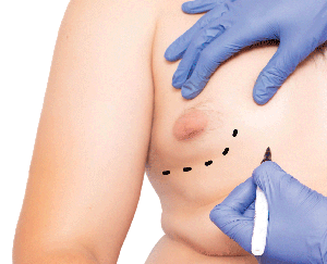 GYNECOMASTIA