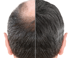 HAIR TRANSPLANTATION