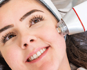 MICRONEEDLING RADIOFREQUENCY