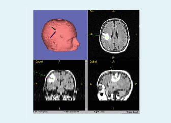 Neuronavigation