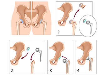 Paediatric Hip Pathologies Managed with Safe Surgical Dislocation