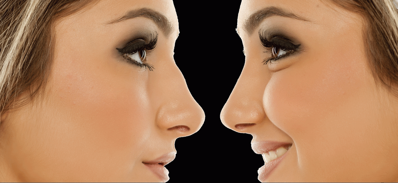 RHINOPLASTY