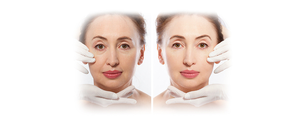 Brow lift with BOTOX® aka BROWTOX