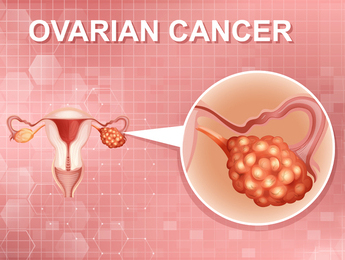 Ovarian Cancer: Causes, Indications, Signs, Symptoms and Treatment