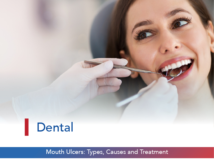 Mouth Ulcers: Types, Causes, and Treatment