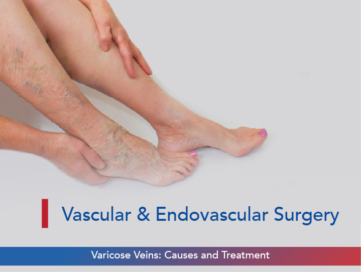 Varicose Veins: Causes and Treatment