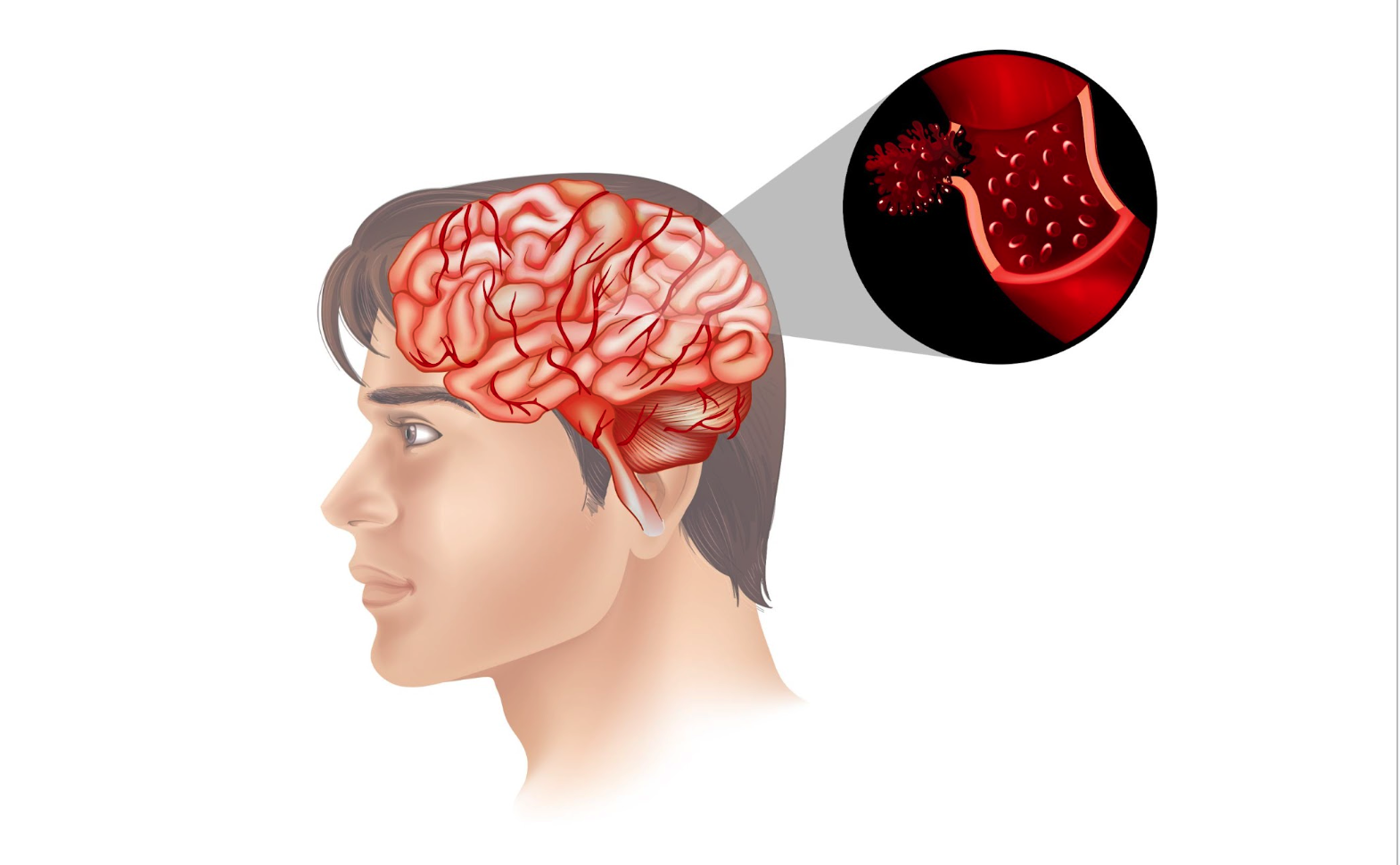 Neuro Surgery Image