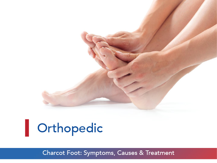 Charcot Foot
