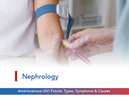 Understanding Arteriovenous (AV) Fistula