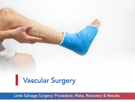 Limb Salvage Surgery: Procedure, Risks, Recovery & Results